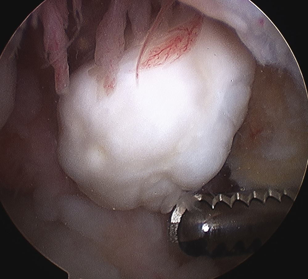 Knee Loose Body Arthroscopy